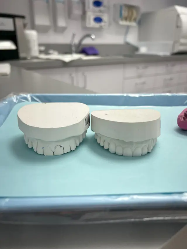 Two white stone dental models of upper and lower teeth on a blue tray