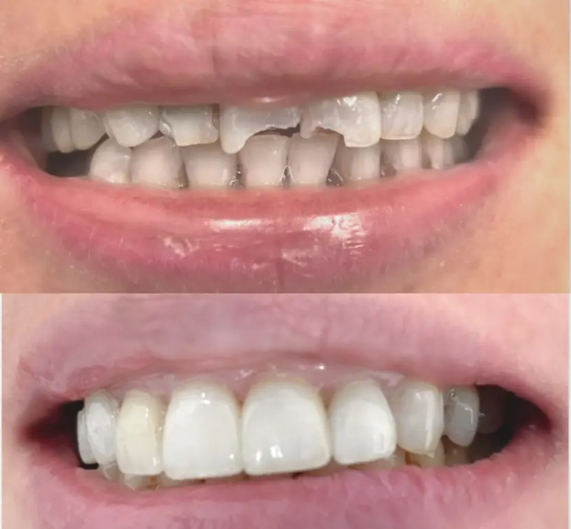 Before and after of front teeth restored with crowns and veneers